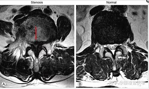 天气潮湿椎管狭窄会加重吗_天气潮湿椎管狭窄