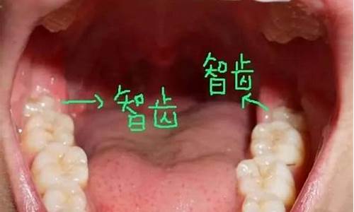 天气热能拔智齿吗_天气热可以拔智齿吗